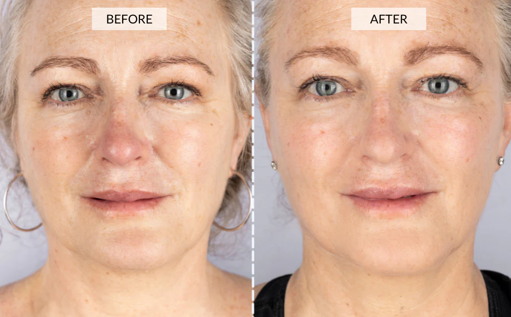 CurrentBody Skin LED Light Therapy Mask + 5 Hydrogel Masks - Image 4